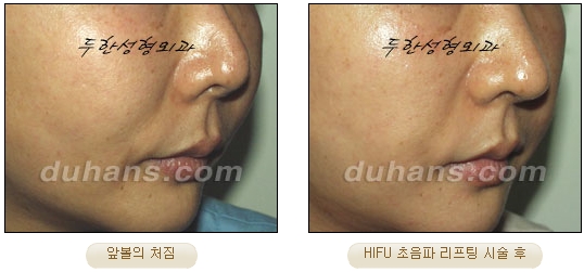 [Duhan Plastic Surgery Lift] - [Double Chin, Drooping Cheeks, Sagging Neck Skin, Wrinkle Improvement] image 15