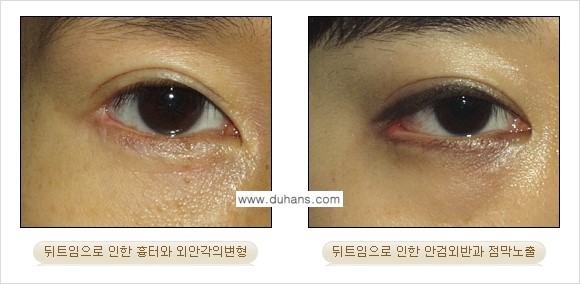 [두한성형외과 NO.1 눈성형] - [뒤트임 수술에 대한 정보] 관련 이미지 9