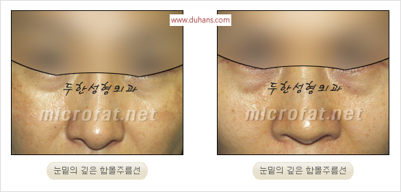 [두한성형외과 경쟁력 눈밑성형 리더] - [윗눈꺼풀 지방제거, 눈밑지방제거, 눈밑지방재배치, 눈밑지방이식 안내] 관련 이미지 13