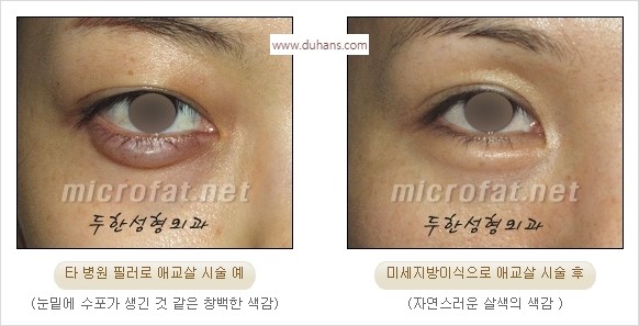 [두한성형외과 경쟁력 눈밑성형] - [눈밑애교살 시술을 위한 미세지방이식] 관련 이미지 14