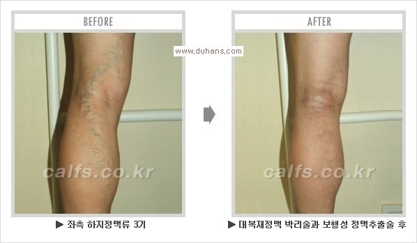 ⁠⁠[두한성형외과 경쟁력 멀티종아리성형] - [종아리성형 전후 주의해야 할 사항] 관련 이미지 15
