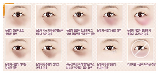 두한성형외과 눈밑수술 - 다크서클 수술 전후 관리 안내 관련 이미지 1