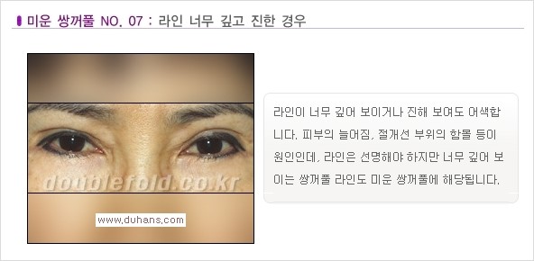 [두한성형외과 경쟁력 쌍꺼풀 재수술, 극한 재수술] - [일반적인 기준의 미운 쌍꺼풀과 아름다운 쌍꺼풀 안내] 관련 이미지 7