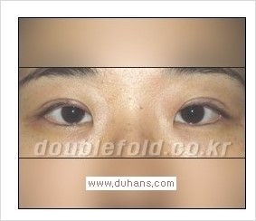 [두한성형외과 경쟁력 쌍꺼풀 재수술] - [Dr. 컬럼 - "재수술의 이상적인 목표"] 관련 이미지 5