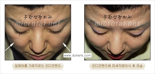 [두한성형외과의 경쟁력 미세지방이식] - [귀족수술과 인디언밴드 미세지방이식 안내 ③] 관련 이미지 6