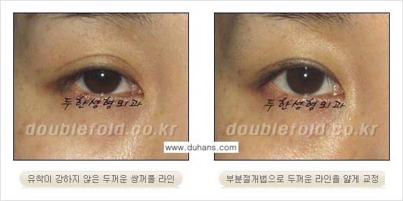 쌍꺼풀 재수술 Dr. 컬럼 관련 이미지 4