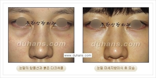 [두한성형외과 경쟁력 눈밑성형] - [꺼진 눈밑, 눈밑 함몰 주름선 눈밑 미세지방이식 안내] 관련 이미지 29