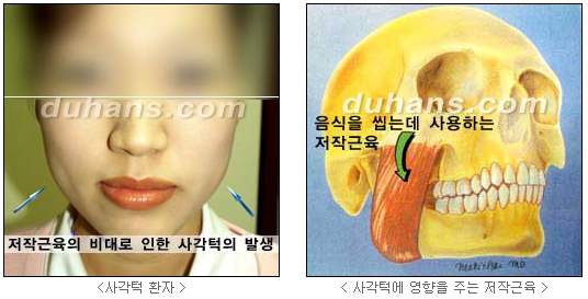 [Duhan Plastic Surgery Clinic Aesthetic Procedures] - [Square Jaw Botox] image 3