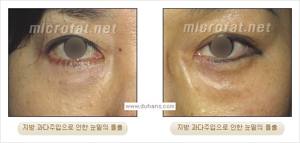 [두한성형외과 경쟁력 미세지방이식] - [미세지방이식, 자가지방이식, 지방이식, 지방주입에 대한 잘못된 정보] 관련 이미지 17