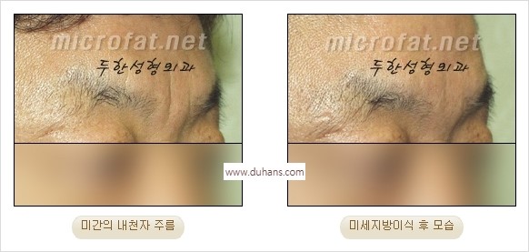 [두한성형외과 경쟁력 동안성형 리더] - ​[미간주름, 이마주름, 안검성형, 이마거상술, 눈썹거상술] 관련 이미지 12