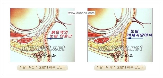 [두한성형외과 경쟁력 눈밑성형] - [눈밑 다크써클, 눈밑 주름의 교정 안내 1.] 관련 이미지 8