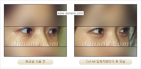 [두한성형외과 경쟁력 미세지방이식] - [탄력있는 피부와 윤곽을 만들어주는 Col-fat 지방이식] 관련 이미지 11