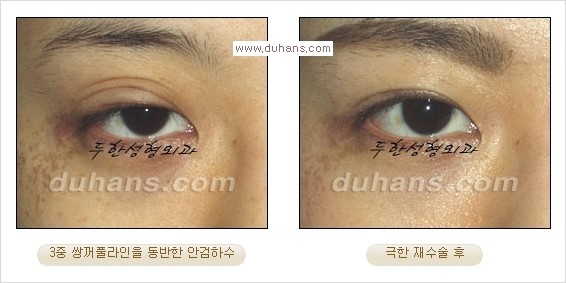 [두한성형외과 경쟁력 눈성형] - [Dr. 컬럼  "어떤 쌍꺼풀이 아름다운 쌍꺼풀인가?!] 관련 이미지 5