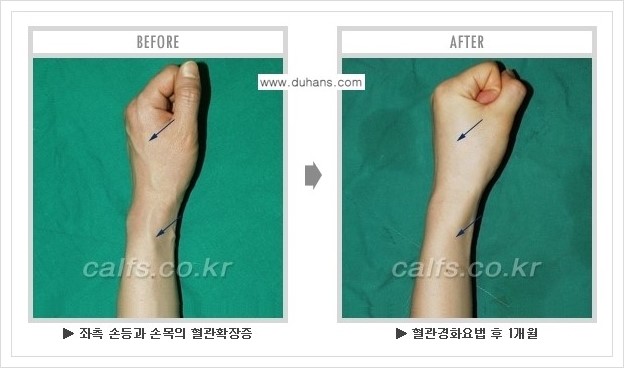 ⁠⁠[두한성형외과 정맥류 치료] - [손, 팔 정맥확장증 사진자료 안내 ②] 관련 이미지 4