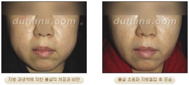 [두한성형외과 안전한 지방흡입] - [얼굴지방흡입] 관련 이미지 10
