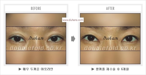 [두한성형외과 경쟁력 눈성형] - [나에게 맞는 어울리는 쌍꺼풀 라인] 관련 이미지 11