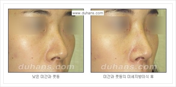 [두한성형외과 경쟁력 코성형] - [자연스러운 코 미세지방이식] 관련 이미지 4