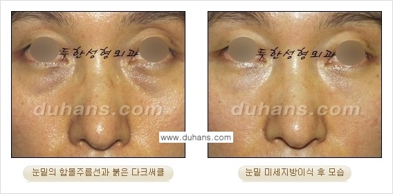 [두한성형외과 상큼하고 환한 눈매완성] - [눈밑 미세지방이식 ①] 관련 이미지 8