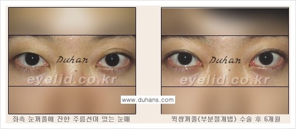 [두한성형외과 NO.1 눈성형] - [절개법과 매몰법 관련 흔한 질문과 답변] 관련 이미지 5