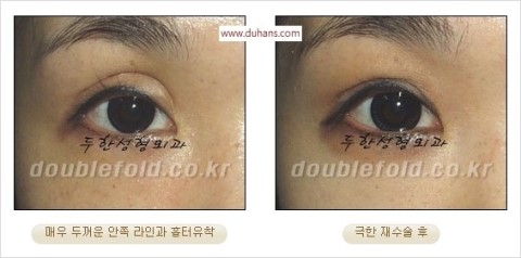 ​[두한성형외과 눈재수술] - [앞트임복원, 뒤트임복원, 쌍꺼풀복원] 관련 이미지 28