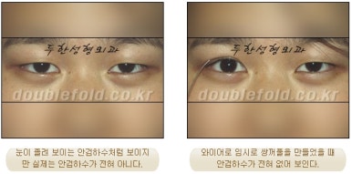 [두한성형외과 눈성형] - [안검하수 재수술] 관련 이미지 7