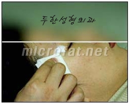 [Duhan Plastic Surgery Wrinkle Improvement] - [Wrinkle Filler Procedure] image 7