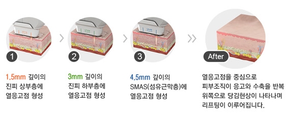 두한성형외과 주름개선 - 주름 HIFU 리프팅 관련 이미지 3