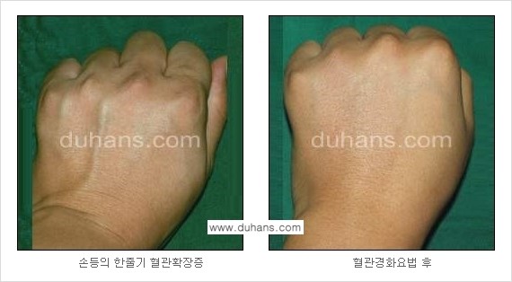 [두한성형외과 정맥 혈관 확장으로 인한 피부개선] - [손, 팔 혈관 확장] 관련 이미지 12