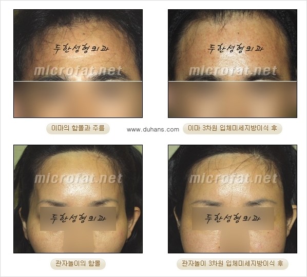 [두한성형외과] - [두한 지방이식의 자부심 콜펫(Col-fat)지방이식] 관련 이미지 5