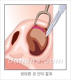 DuHan Plastic Surgery Revision Rhinoplasty - AlloDerm Nose Surgery, SureDerm Nose Surgery image 6