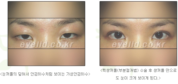 [Duhan Plastic Surgery Secondary Double Eyelid Surgery] - [Sleepy Eye Appearance, Asymmetrical Eye Appearance, Ptosis] image 11