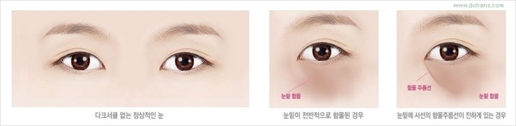 [두한성형외과 경쟁력 눈밑성형] - [다크써클의 원인과 종류, 다크써클의 치료 방법] 관련 이미지 40