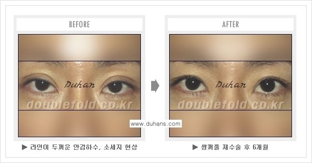 [두한성형외과 경쟁력 쌍꺼풀 재수술, 극한 눈재수술] - [쌍꺼풀 재수술, 극한 눈재수술 관련 자주하는 질문과 답변] 관련 이미지 11