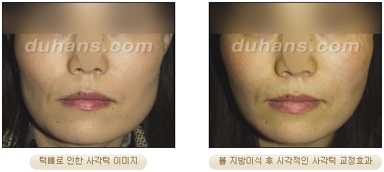 [두한성형외과 얼굴자가지방이식] - [볼살, 이마, 측두부] 관련 이미지 20