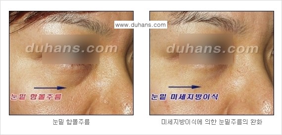 [두한성형외과 경쟁력 미세지방이식] - [다크써클 & 눈밑주름 미세지방이식 4.] 관련 이미지 3