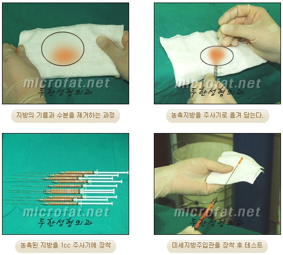 Fat Grafting Leader Duhan Plastic Surgery - Everything About Fat Grafting image 60