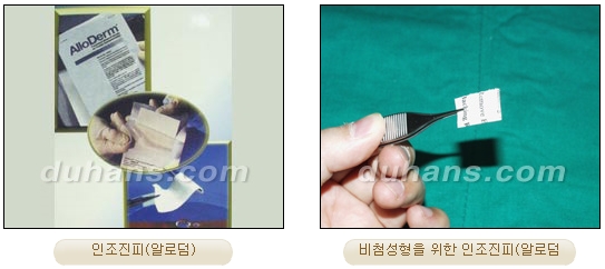 Duhan Plastic Surgery Rhinoplasty - Revision Rhinoplasty Methods image 5