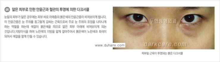[두한성형외과 NO.1 경쟁력] - [원인과 색에 따른 다크써클의 종류] 관련 이미지 6