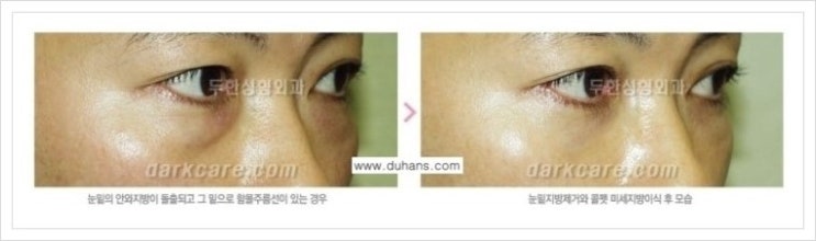 [두한성형외과 경쟁력 다크써클 교정] - [눈밑 돌출이 있으면서 그 아래 함몰 주름선이 있는 증상 개선 방법 안내] 관련 이미지 4