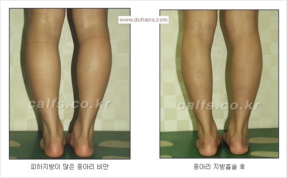 ⁠⁠[두한성형외과 경쟁력 멀티종아리성형] - [종아리성형 전후 주의해야 할 사항] 관련 이미지 8