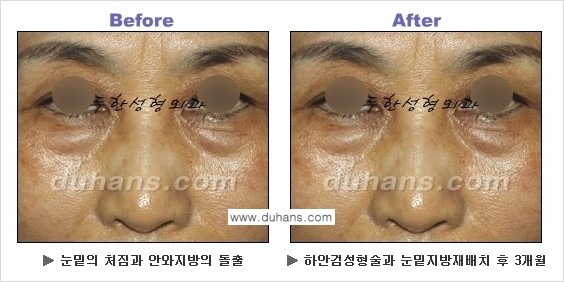 [두한성형외과의 상큼하고 환한 젊은 눈매완성] - [하안검 성형술 ①] 관련 이미지 17