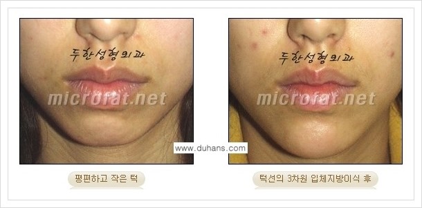 ⁠⁠[두한성형외과 경쟁력 미세지방이식] - [턱 미세지방이식 - 안면윤곽 교정 안내] 관련 이미지 14