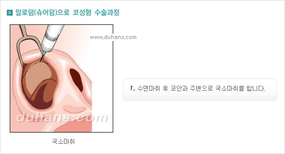 [두한성형외과 경쟁력 코성형] - [코성형을 위한 알로덤(슈어덤) 수술, 실리콘 수술 안내] 관련 이미지 4