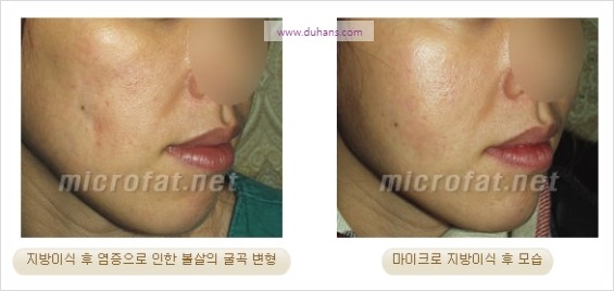 [두한성형외과 경쟁력 지방이식] - [두한 자가지방이식 클리닉 안내]​ 관련 이미지 83