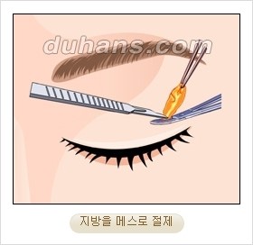 ⁠⁠[두한성형외과 경쟁력 안검성형] - [젊은 눈매를 위한 윗눈꺼풀 지방제거, 눈밑 지방제거] 관련 이미지 7
