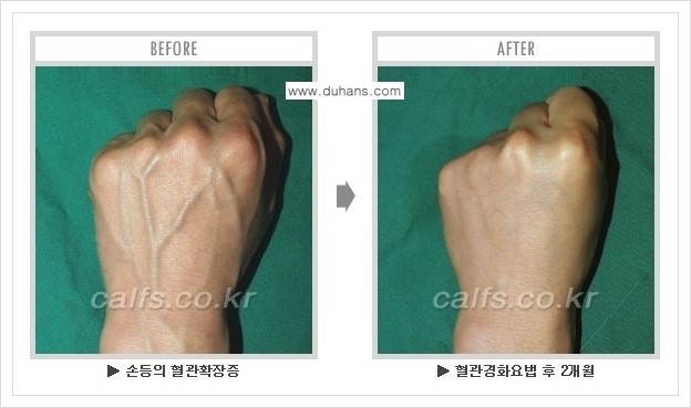 ⁠⁠[두한성형외과 정맥류 치료] - [손, 팔 정맥확장증 사진자료 안내 ②] 관련 이미지 3