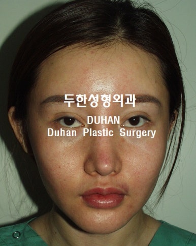 [DuHan Plastic Surgery Double Eyelid Surgery] - [Frequently Asked Questions and Answers About Eye Plastic Surgery] image 21