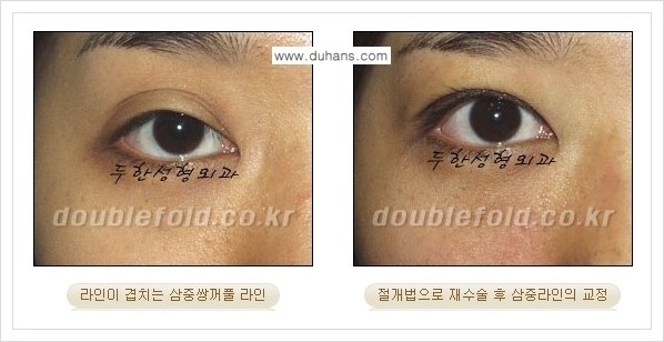 [두한성형외과 경쟁력 쌍꺼풀 재수술] - [삼중 쌍꺼풀 라인의 교정 안내] 관련 이미지 6