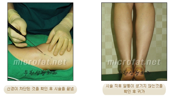 [Duhan Plastic Surgery Clinic Calf Contouring] - [Calf Reduction] image 14