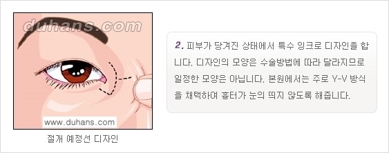 [두한성형외과 NO.1 눈성형] - [몽고주름 제거(앞트임 수술) 2.] 관련 이미지 3
